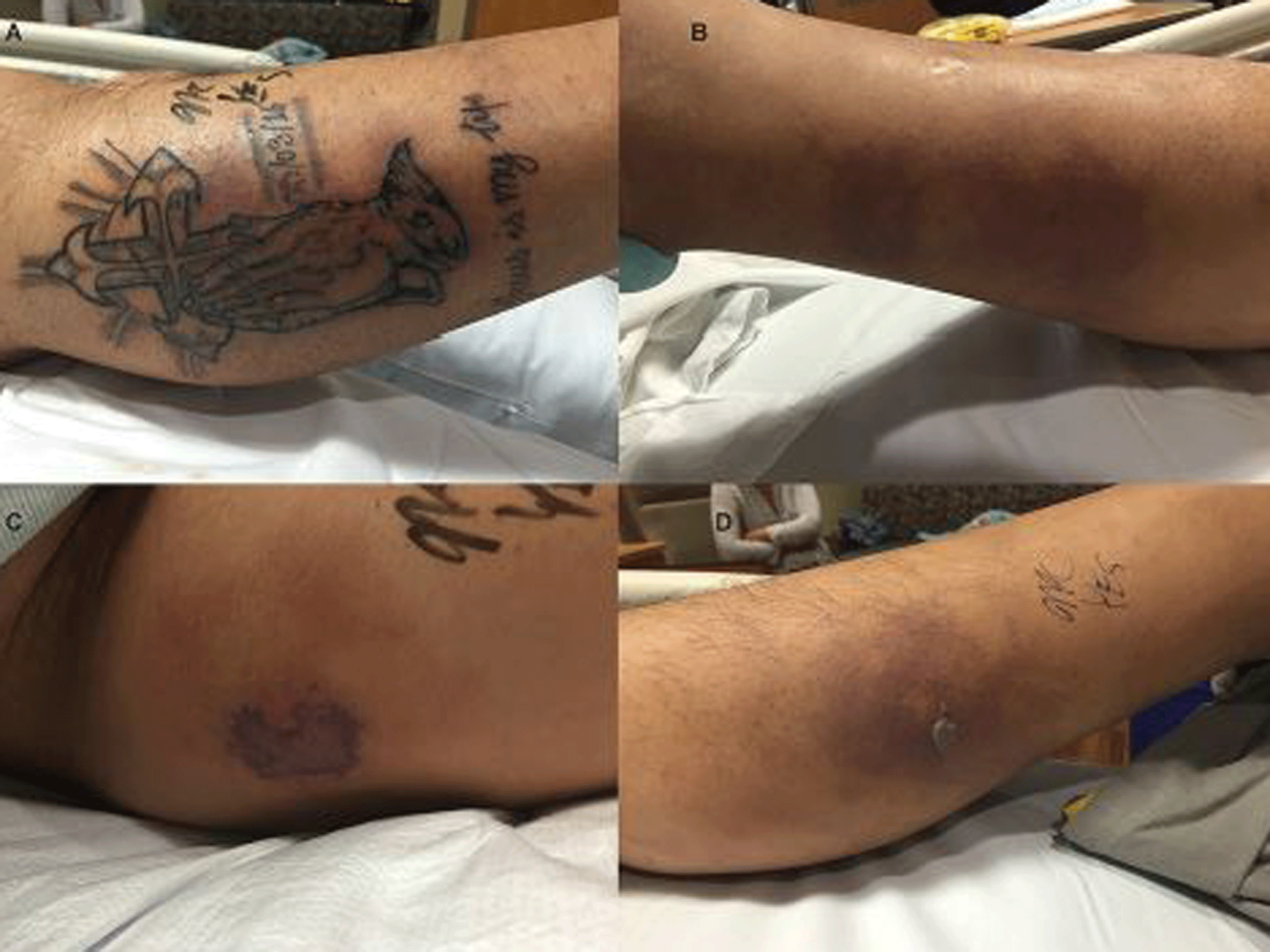 Dangers of swimming with a new tattoo exposed in alarming images of man who died from infection