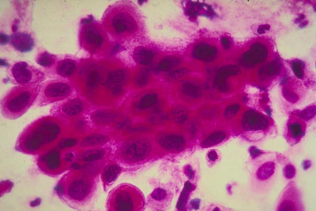 Microscope image of cancer cells in the cervix