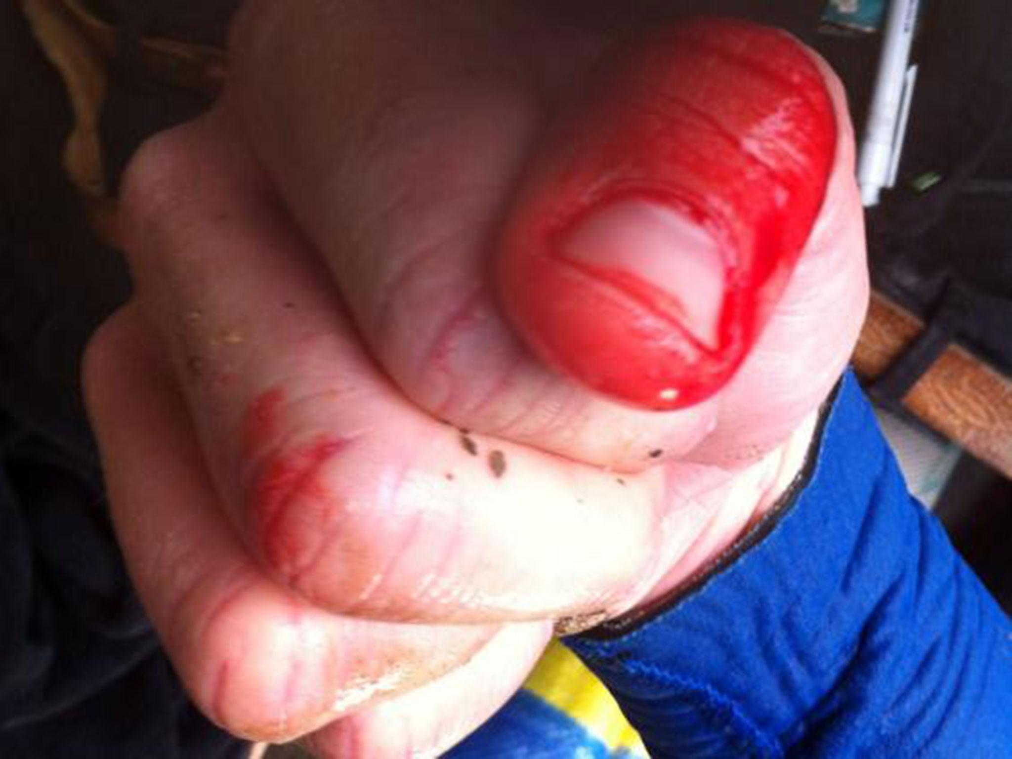 Pictured, Rich Thompson's thumb, injured by the shark