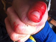 'First shark attack in UK' leaves surfer with bloody thumb