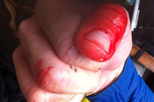 Pictured, Rich Thompson's thumb, injured by the shark
