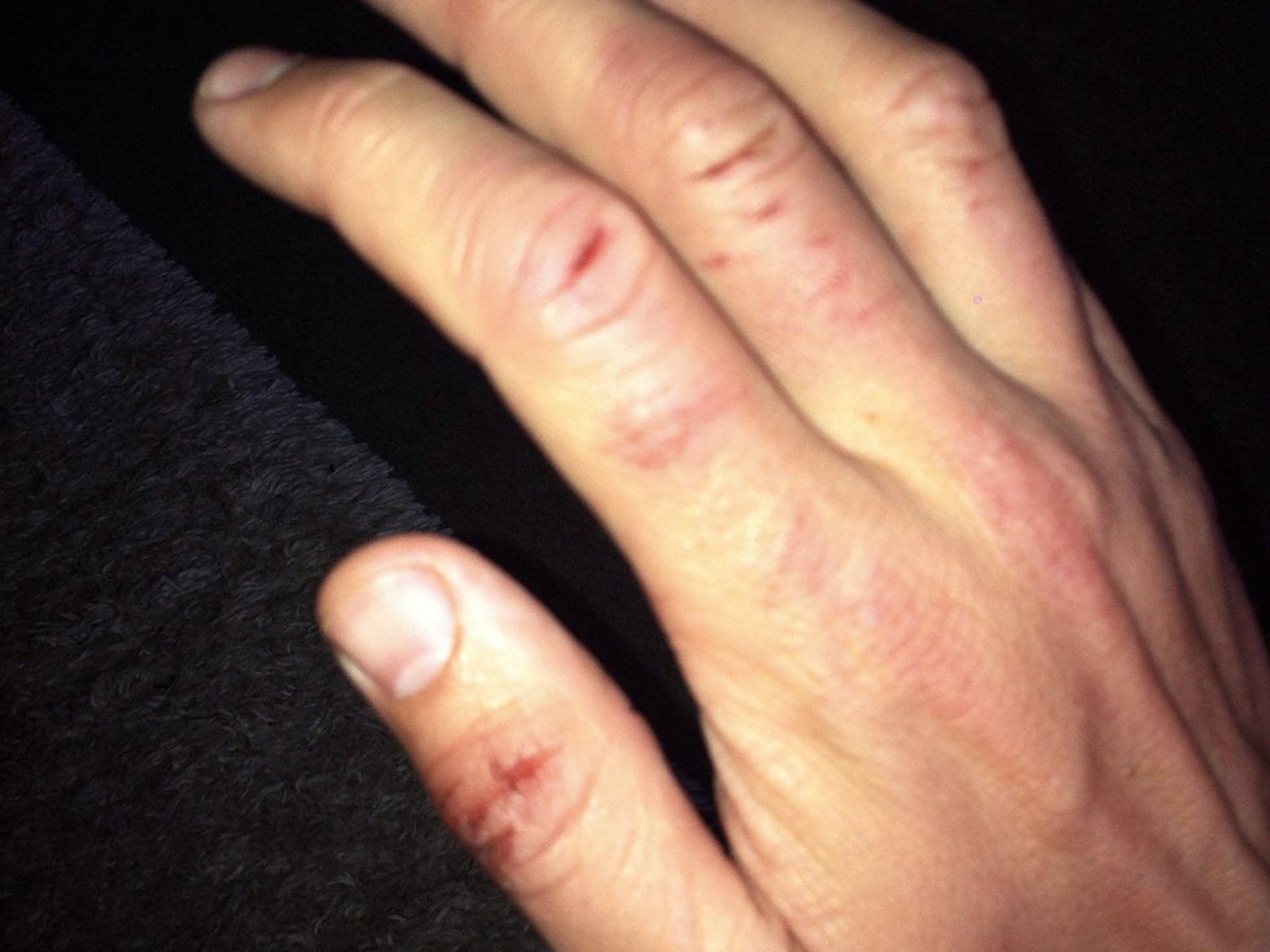 Injuries to the hand of surfer Rich Thomson, who has described how he hit a shark on the head after it bit him while he was in the water off Bantham in South Devon