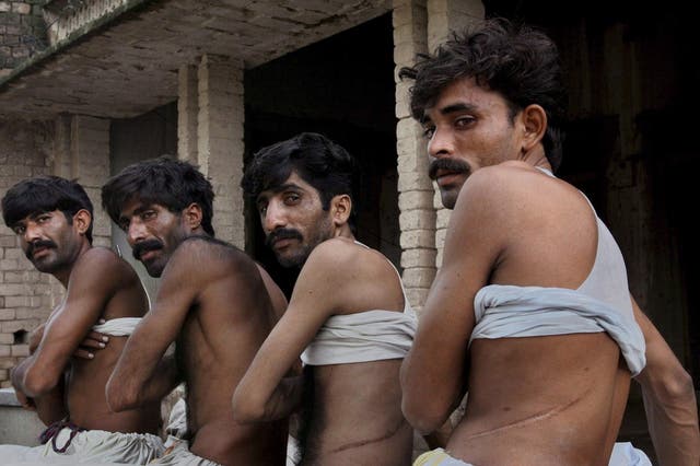 Pakistani men display scars after selling kidneys to pay off debts