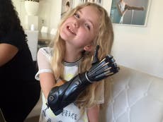 NHS launches world-first trial of 3D printed bionic hands for children