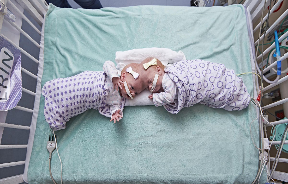 Twin girls conjoined at the head successfully separated by 30-strong  surgical team | The Independent | The Independent