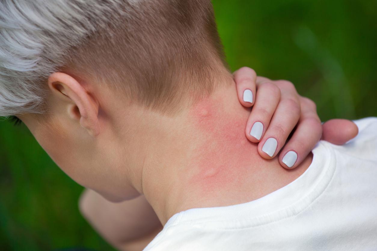 A mosquito bite usually resolves on its own after three days