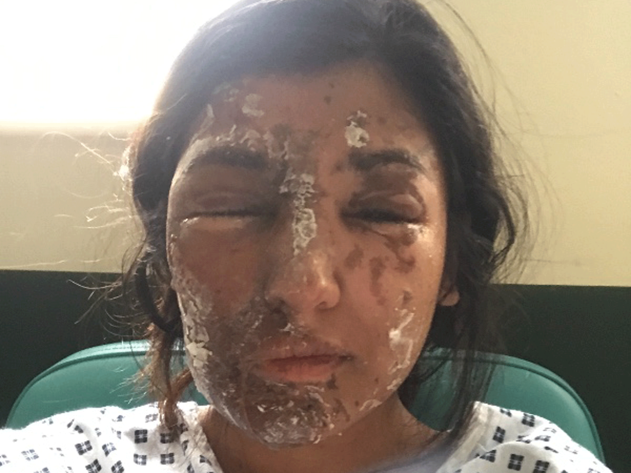 Resham Khan suffered burns to her face and body