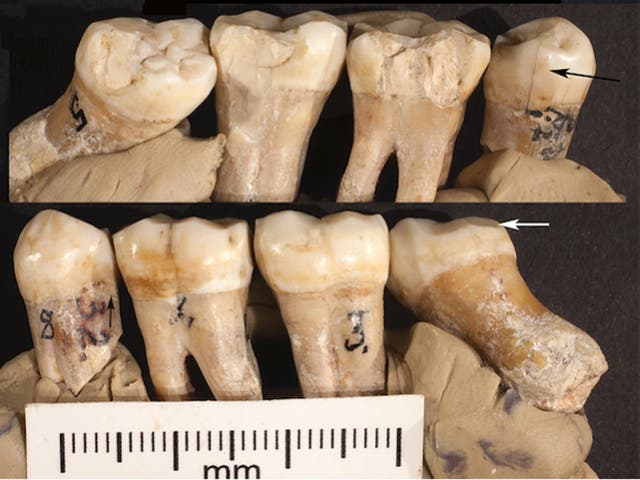 The teeth showed what is being interpreted evidence of primitive attempts to correct problems with them