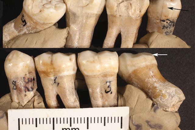The teeth showed what is being interpreted evidence of primitive attempts to correct problems with them