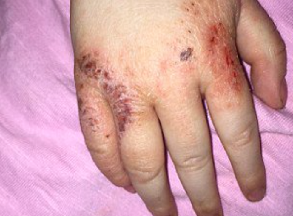 Evie-Rae battled with painful patches on her hands, mouth and backs of knees that she would scratch until she bled