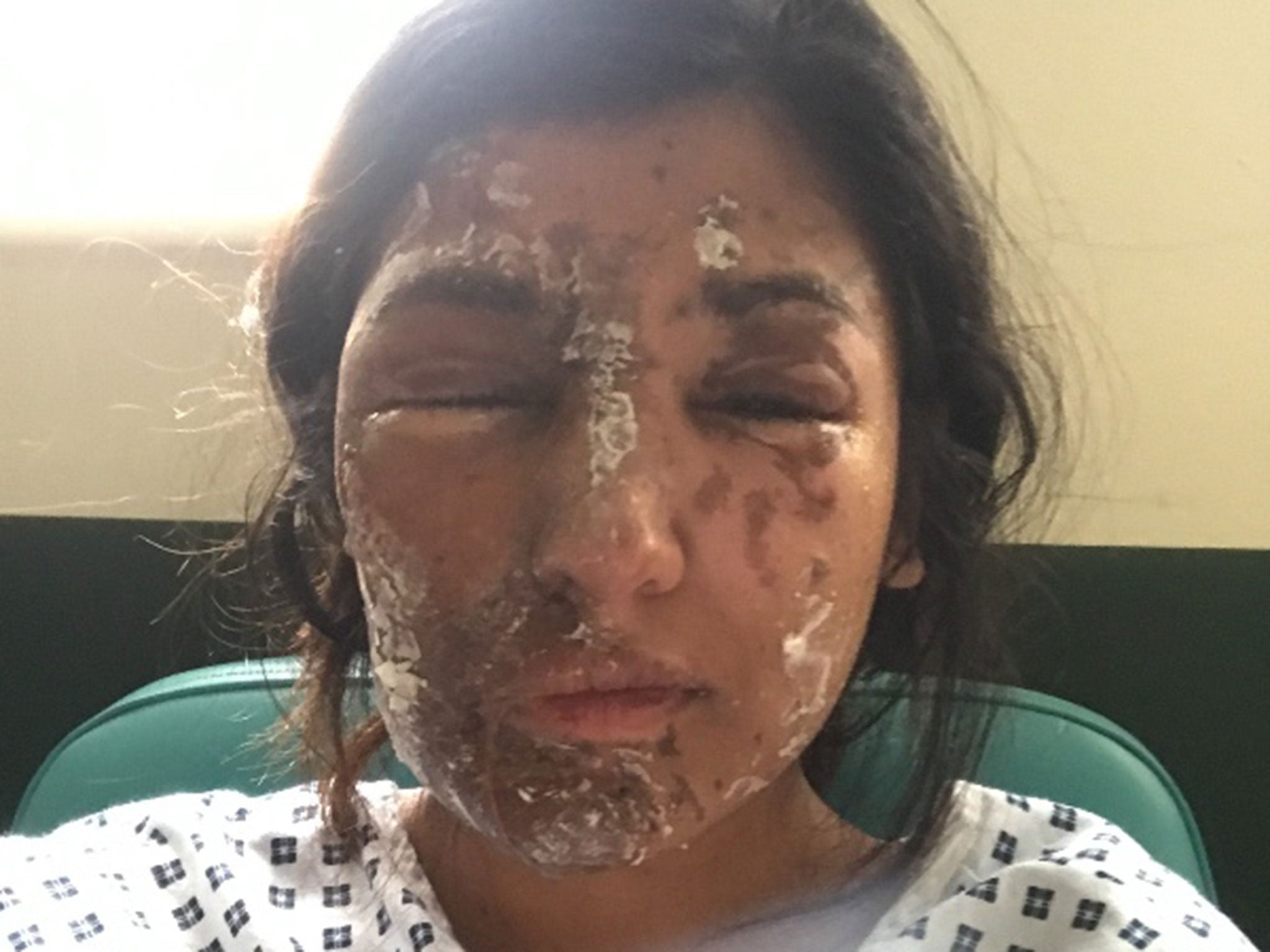 Resham Khan in hospital following an acid attack on 21 June