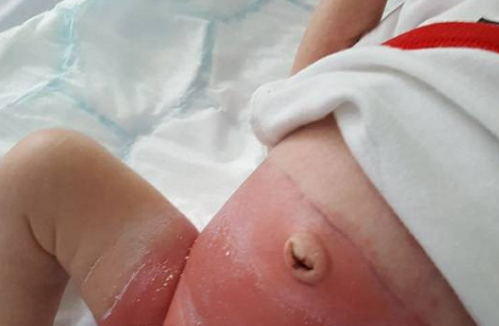 The picture posted by the infant's father Jordan Bartliff on Facebook shows severe irritation and blisters on the baby’s skin