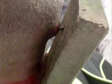Bullies leave plank of wood impaled in 9-year-old's head