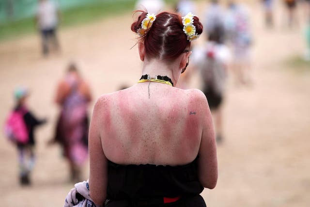 A festivalgoer with a sunburnt back at Glastonbury Festival, at Worthy Farm in Somerset