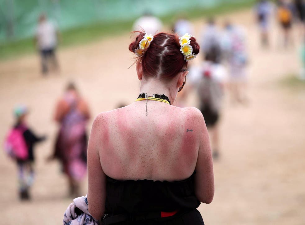Sunburn at Glastonbury: we rarely apply the correct amount of sunscreen