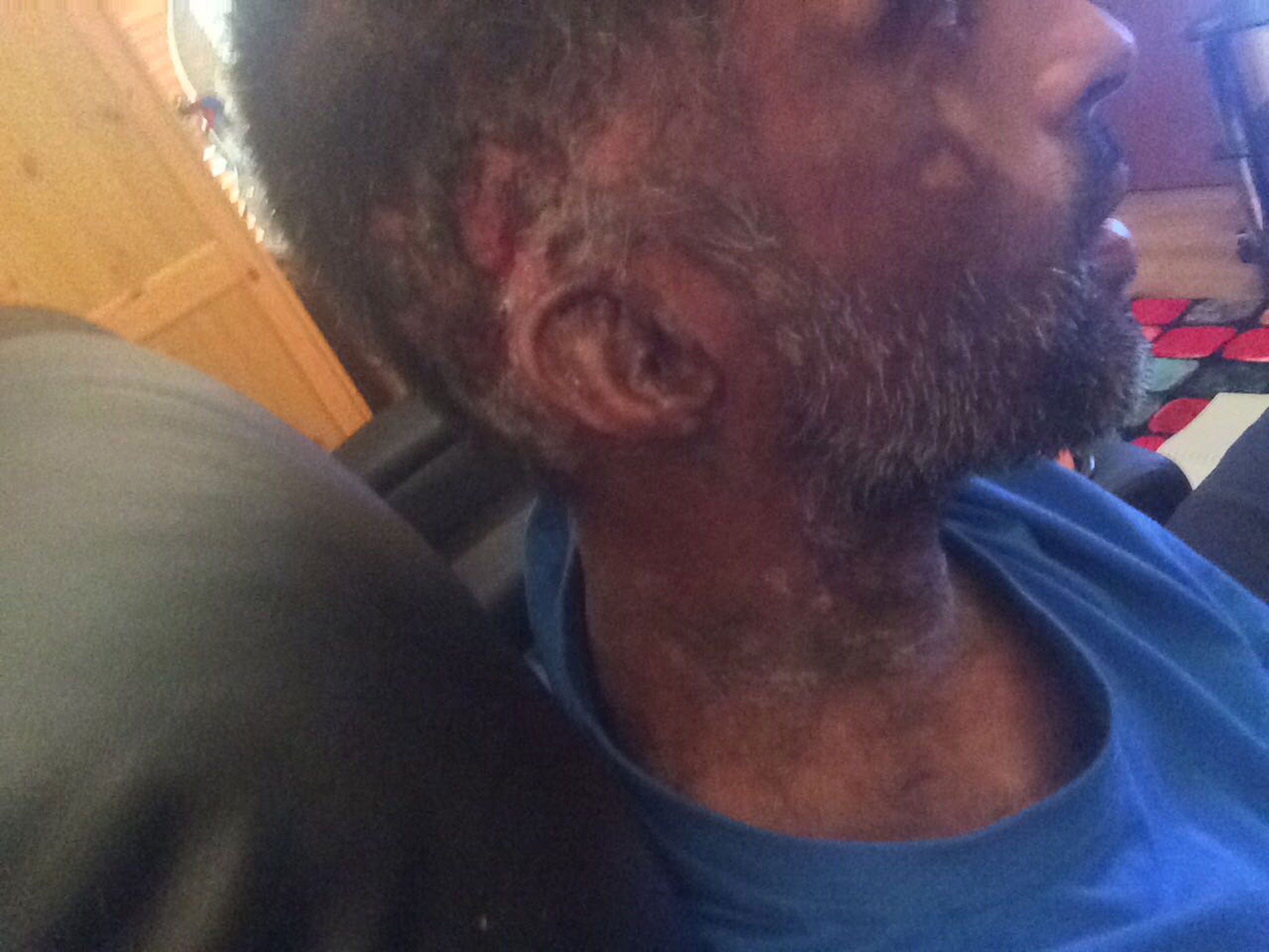Jameel Mukhtar, 37, is deaf in one ear following an acid attack on 21 June