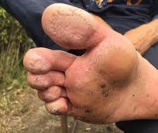 Refugees in Calais suffering trench foot from squalid conditions
