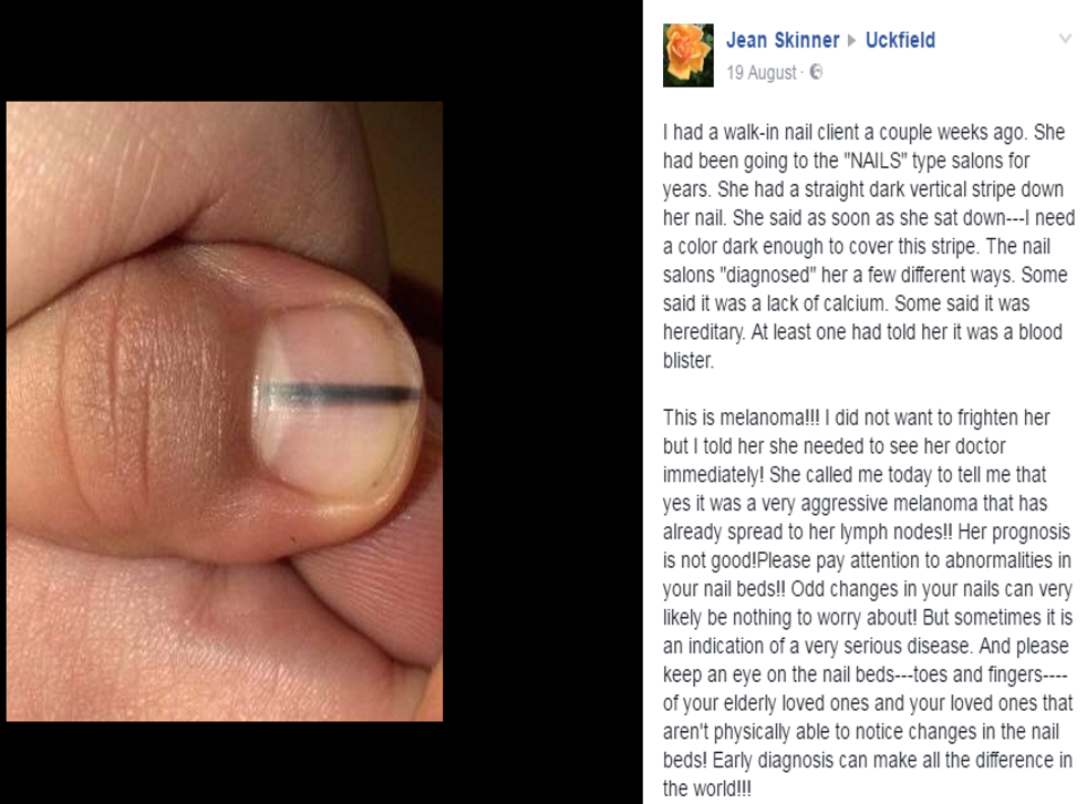 Woman Shares Warning That Black Line On Nail Could Be Sign Of Cancer The Independent The Independent