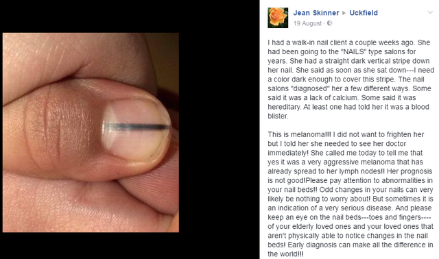 Woman shares warning that 'black line on nail' could be sign of cancer |  The Independent | The Independent