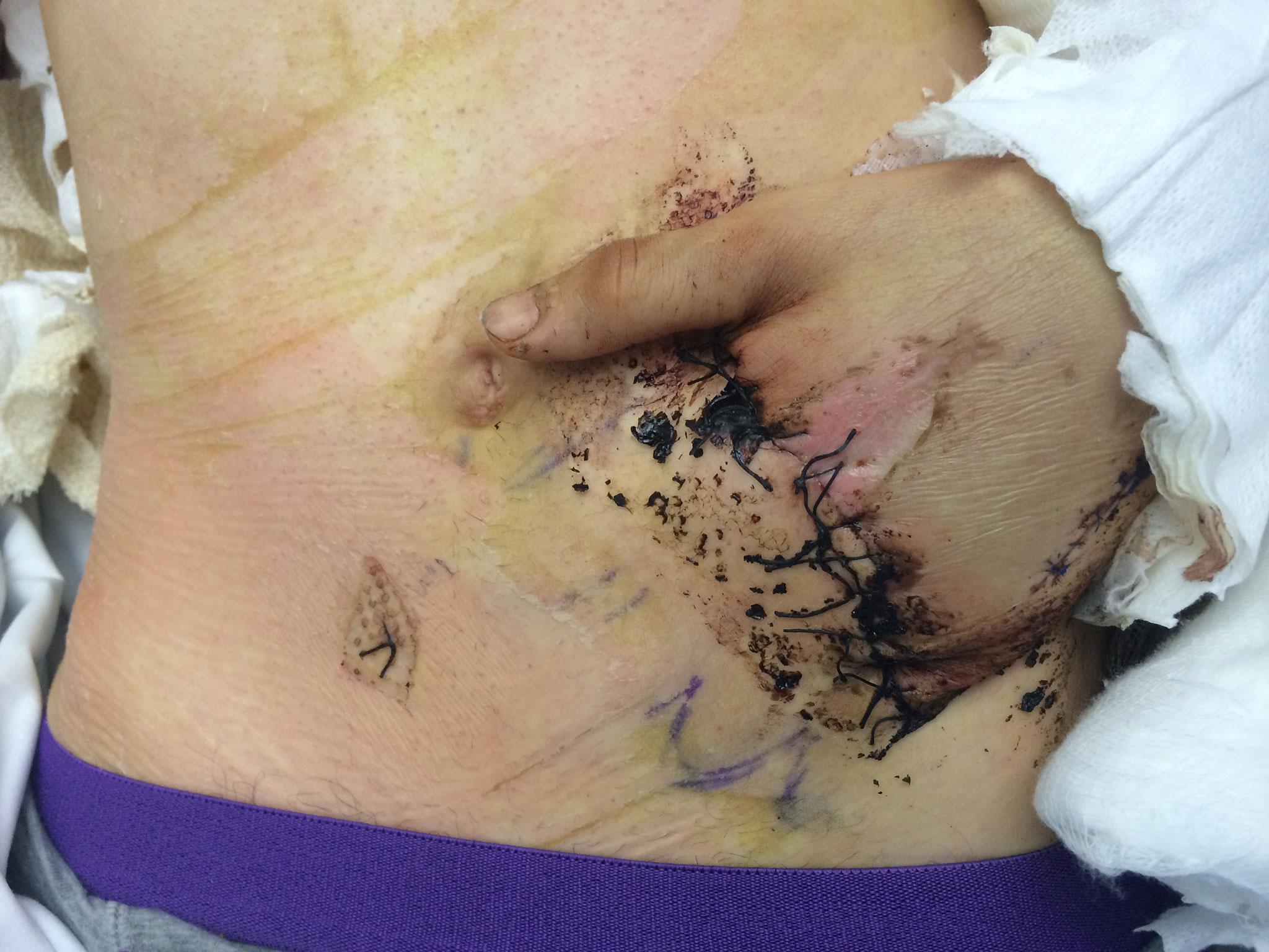 Surgeon's sewed Mr Seward's hand inside a 'pocket' in his abdomen