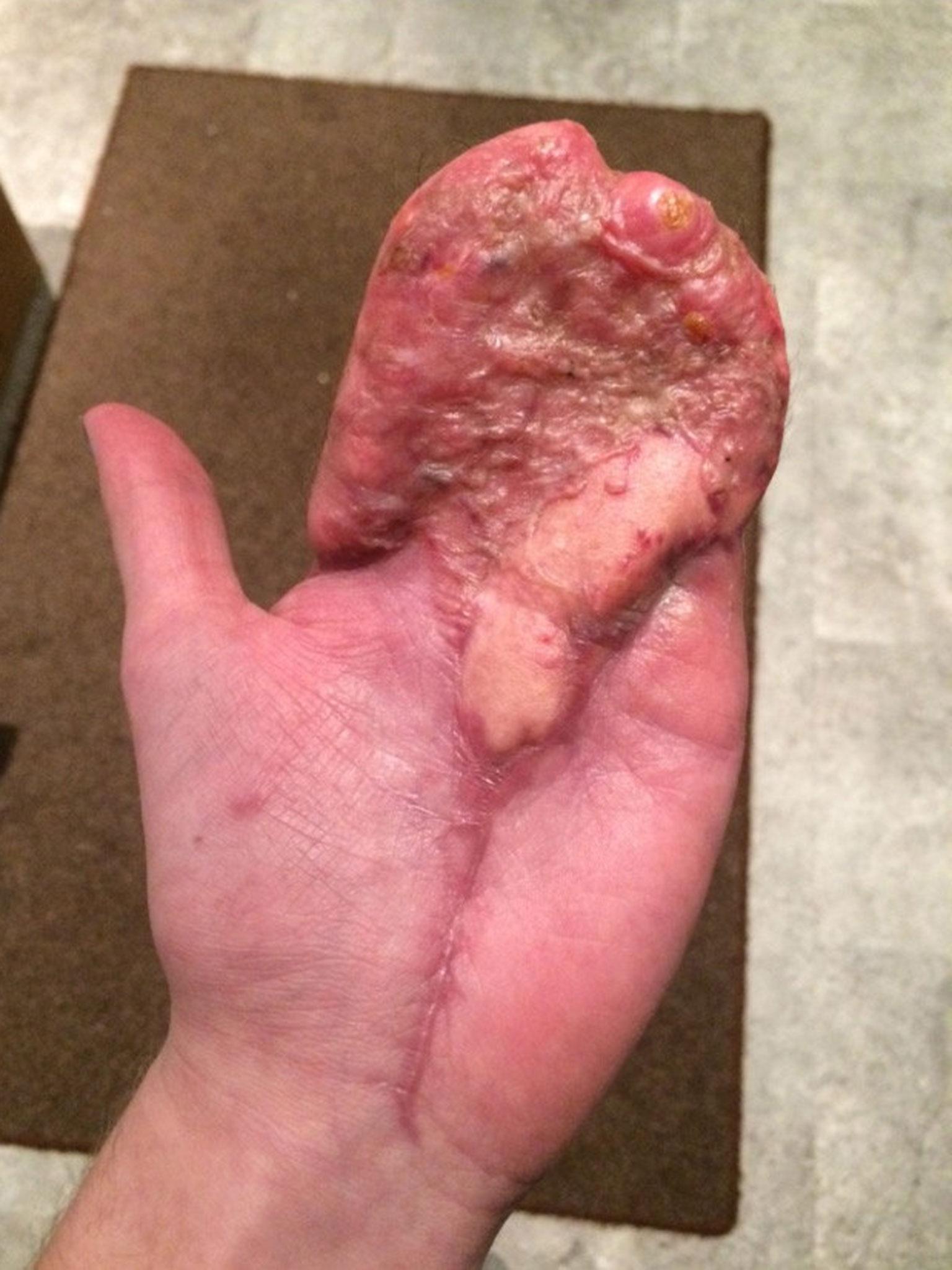 Although the tips of his fingers were amputated in the accident, they may eventually be replaced by transplants from his toes