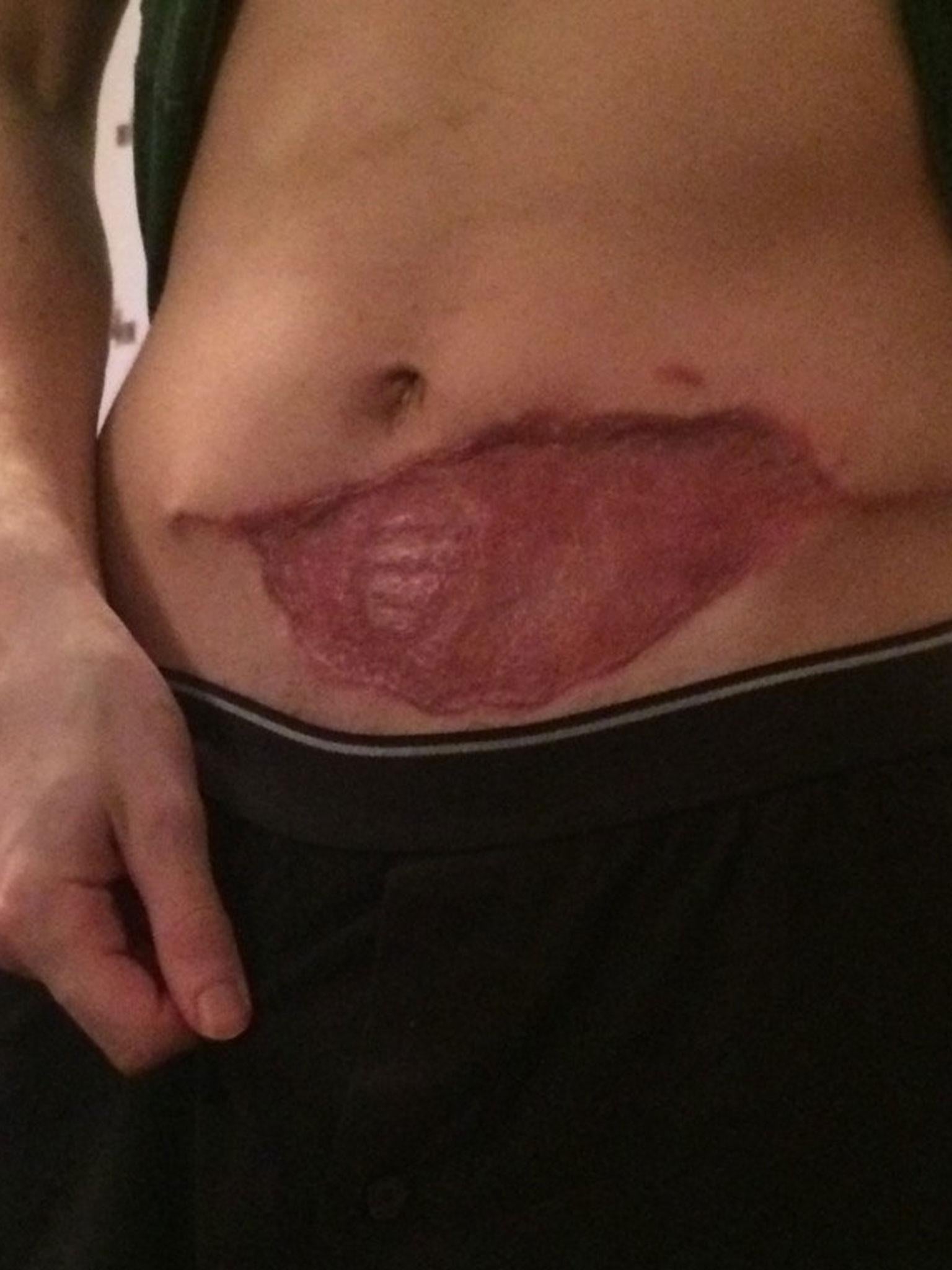 He has since had two operations to separate his fingers so he can move them independently