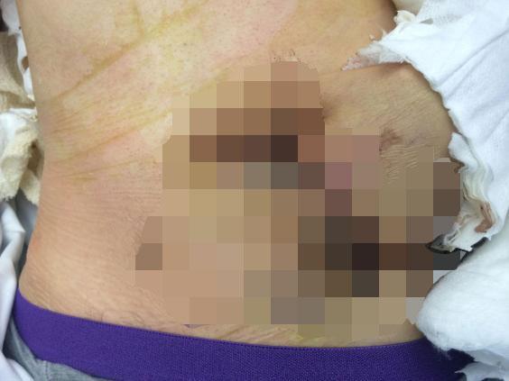 Firefighter's Crushed Hand Saved by Being Sewn Into Belly