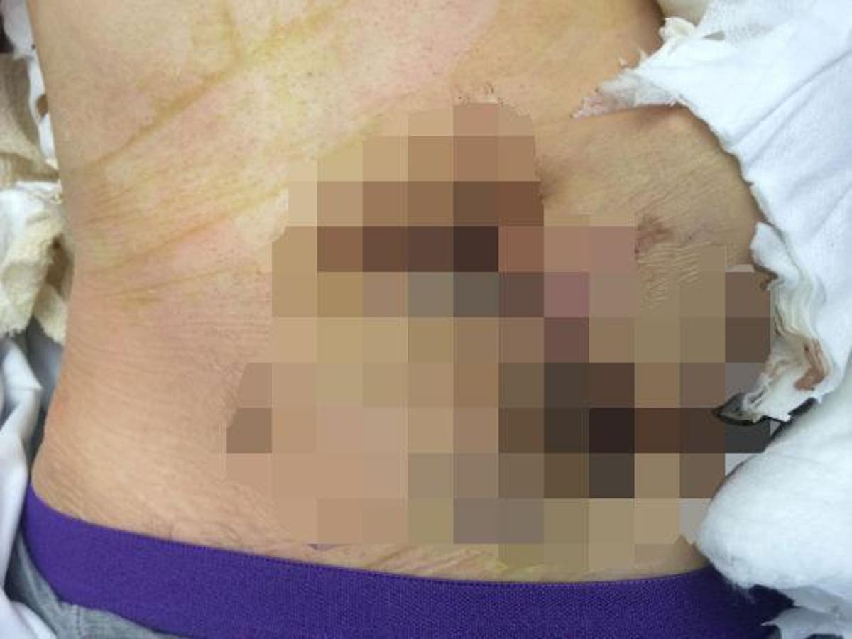 Man's hand sewn inside his abdomen by surgeons after it was mangled in  machine, The Independent