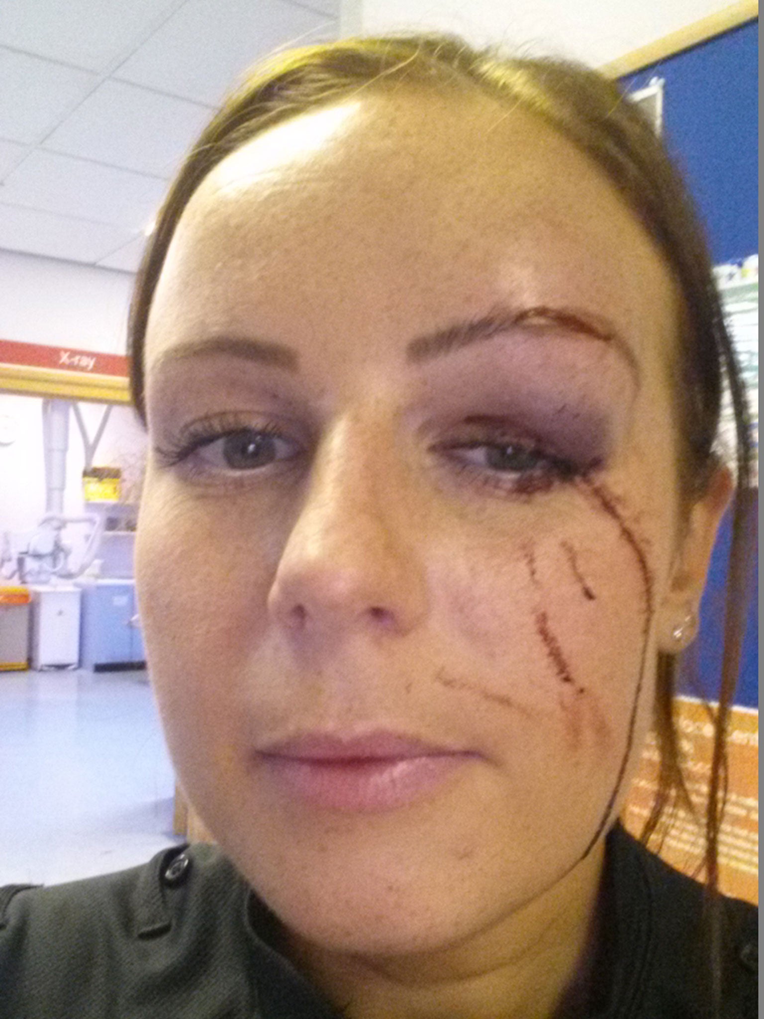 PC Heather Caruana was left with permanent scars after being attacked while helping a colleague