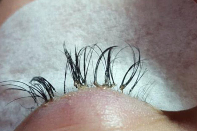 The woman's eyelashes were so damaged that they began to fall out