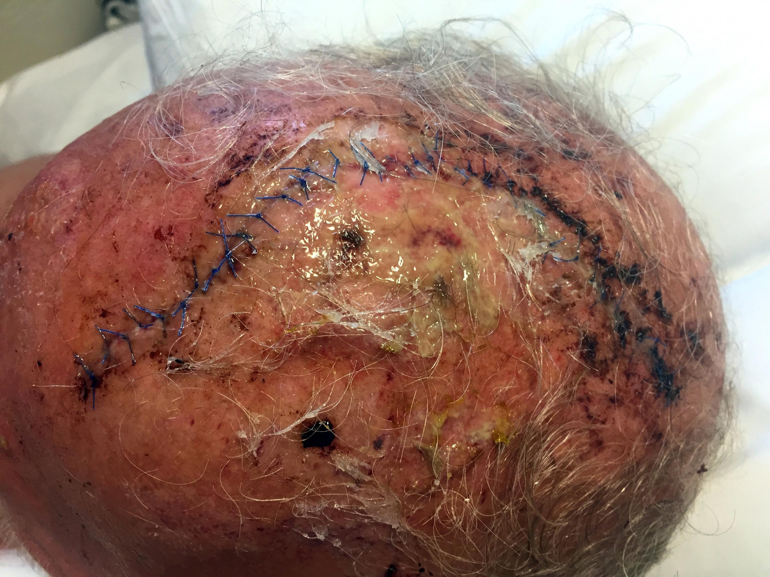 This photo provided by Tom Sommer shows wounds he sustained after the attack