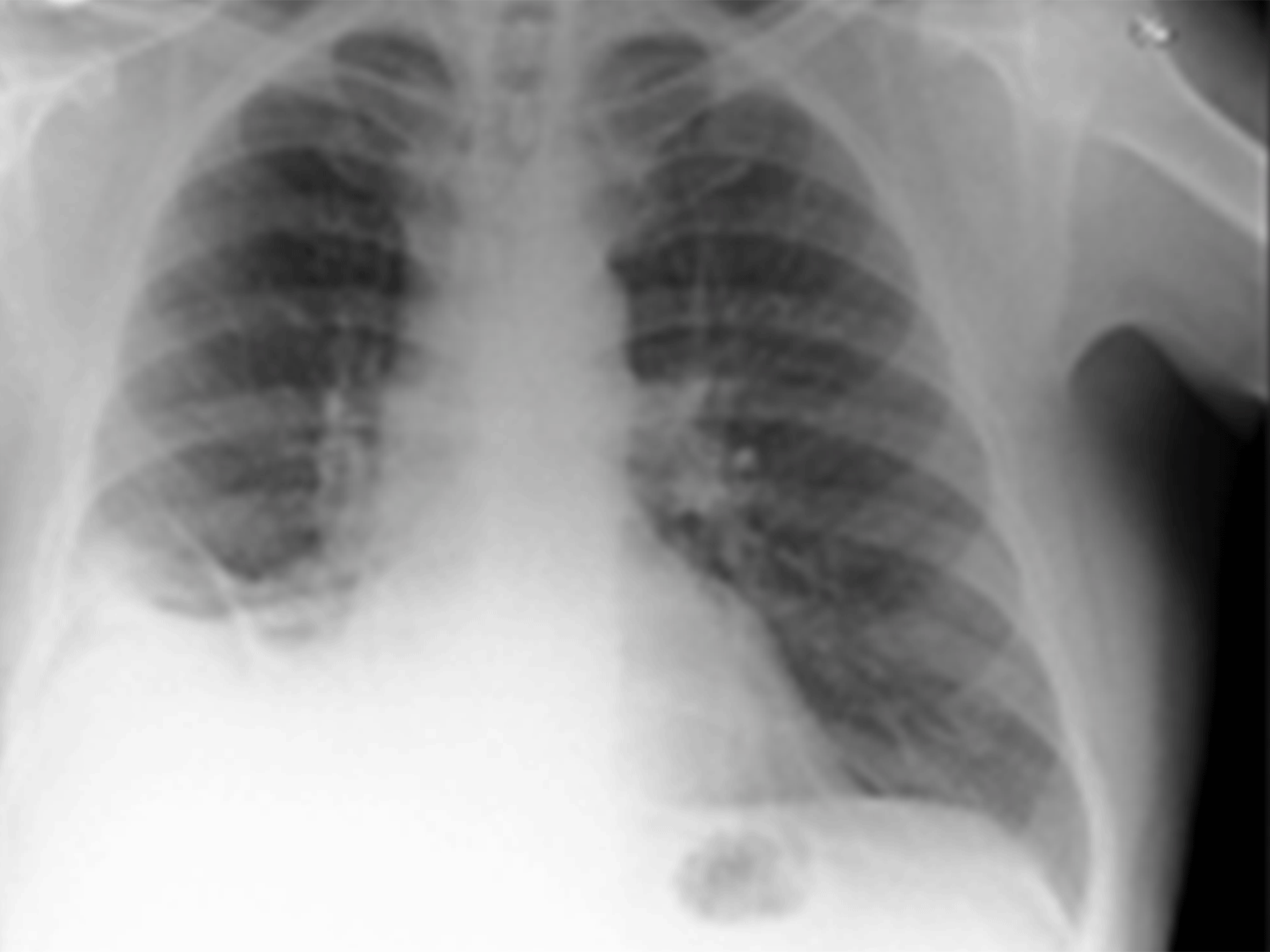 Doctors believed the mass in the bottom left lung was a cancerous tumour