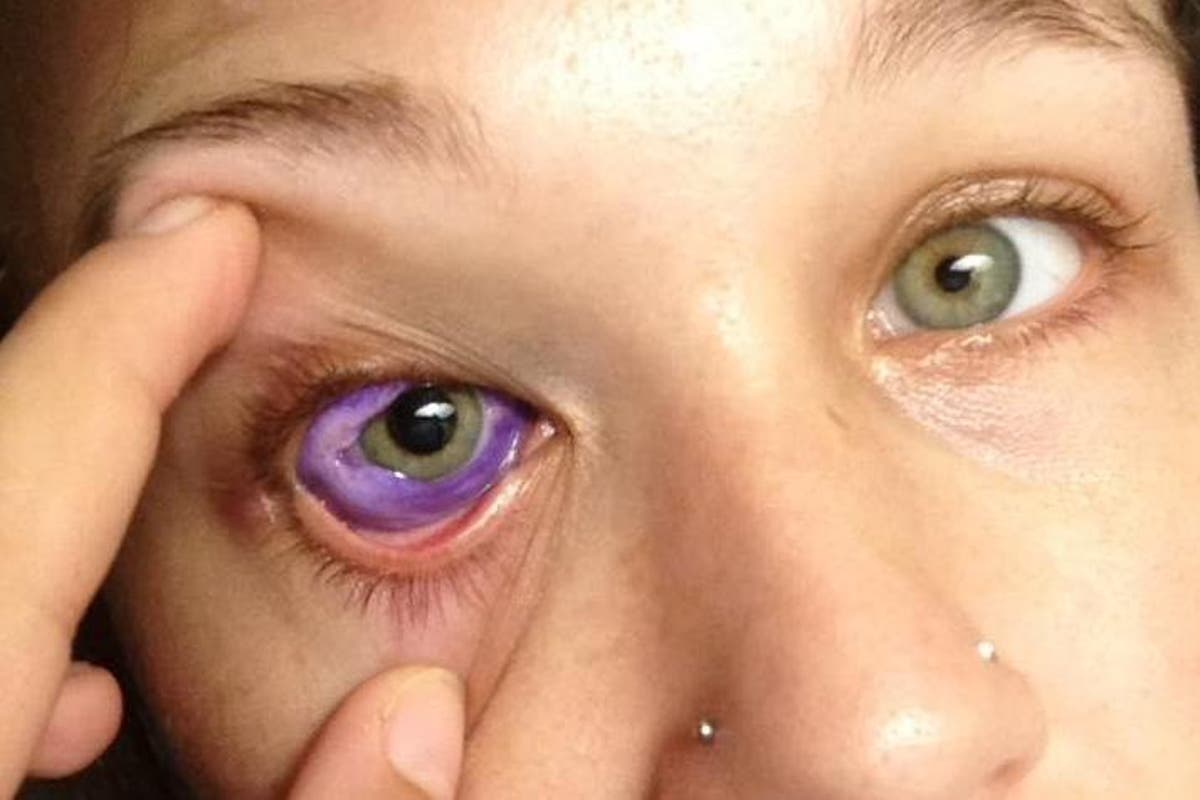 This model's eye tattoo went badly wrong