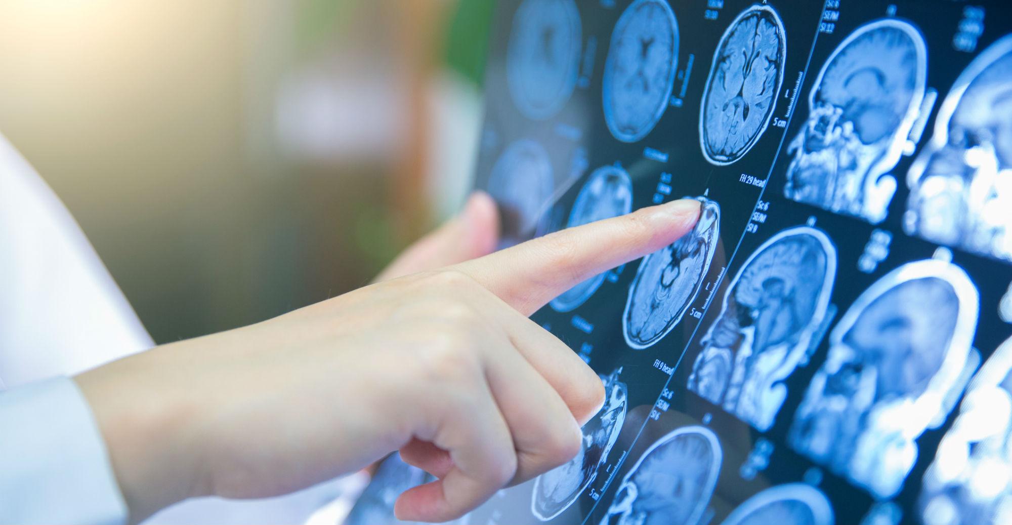 Schizophrenia is 80 study finds indy100 indy100