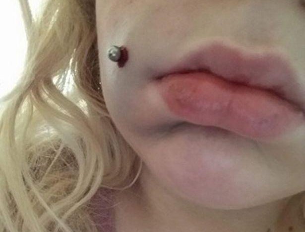 Caitiee's face swelled 'like a balloon' after the botch procedure