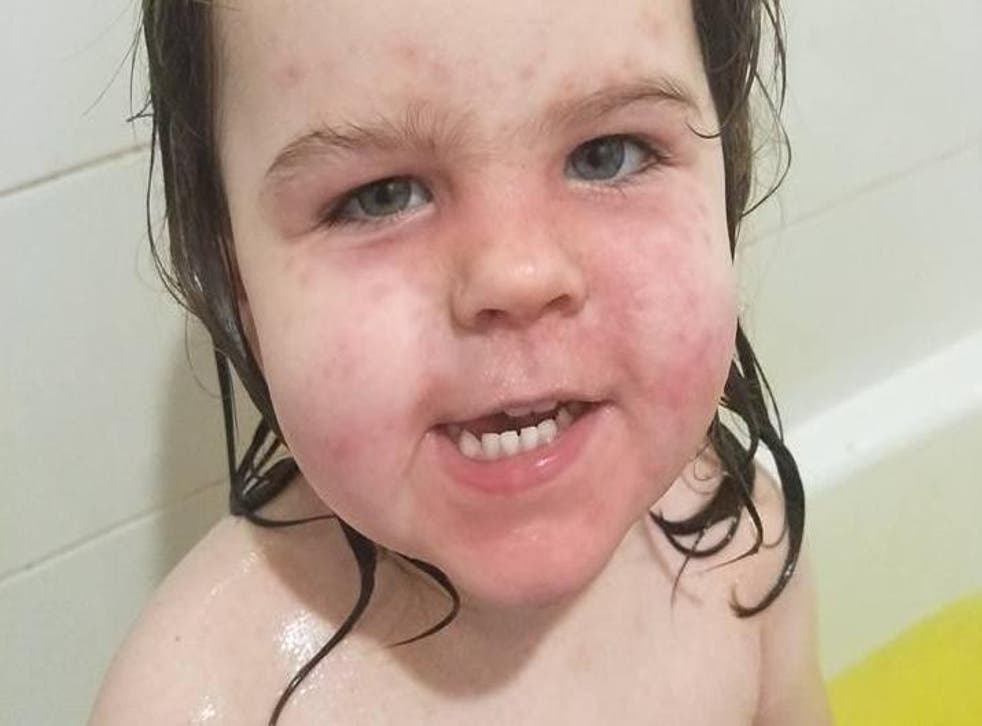 Kallee was left with painful chemical burns on her face and neck