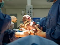 Are babies born by caesarean more likely to be obese?