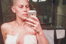 Cancer survivor shares photo of her body after a double mastectomy