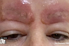 This woman had her eyebrows microbladed and instantly regretted it