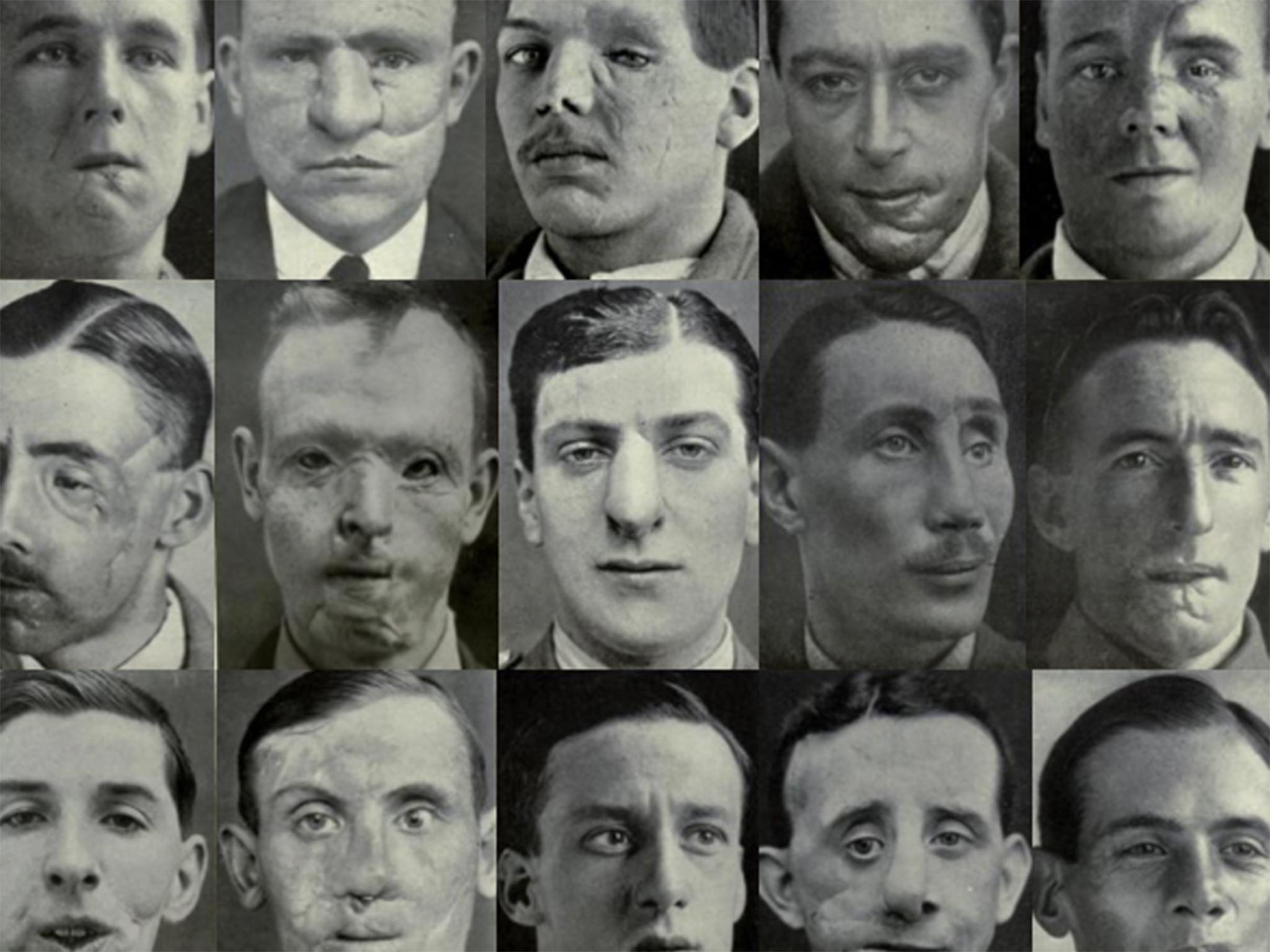 Images from ‘Plastic Surgery of the Face’ by Sir Harold Gillies, 1920