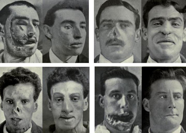 Photos of facially injured First World War servicemen before and after reconstructive treatment (‘Plastic Surgery of the Face’)