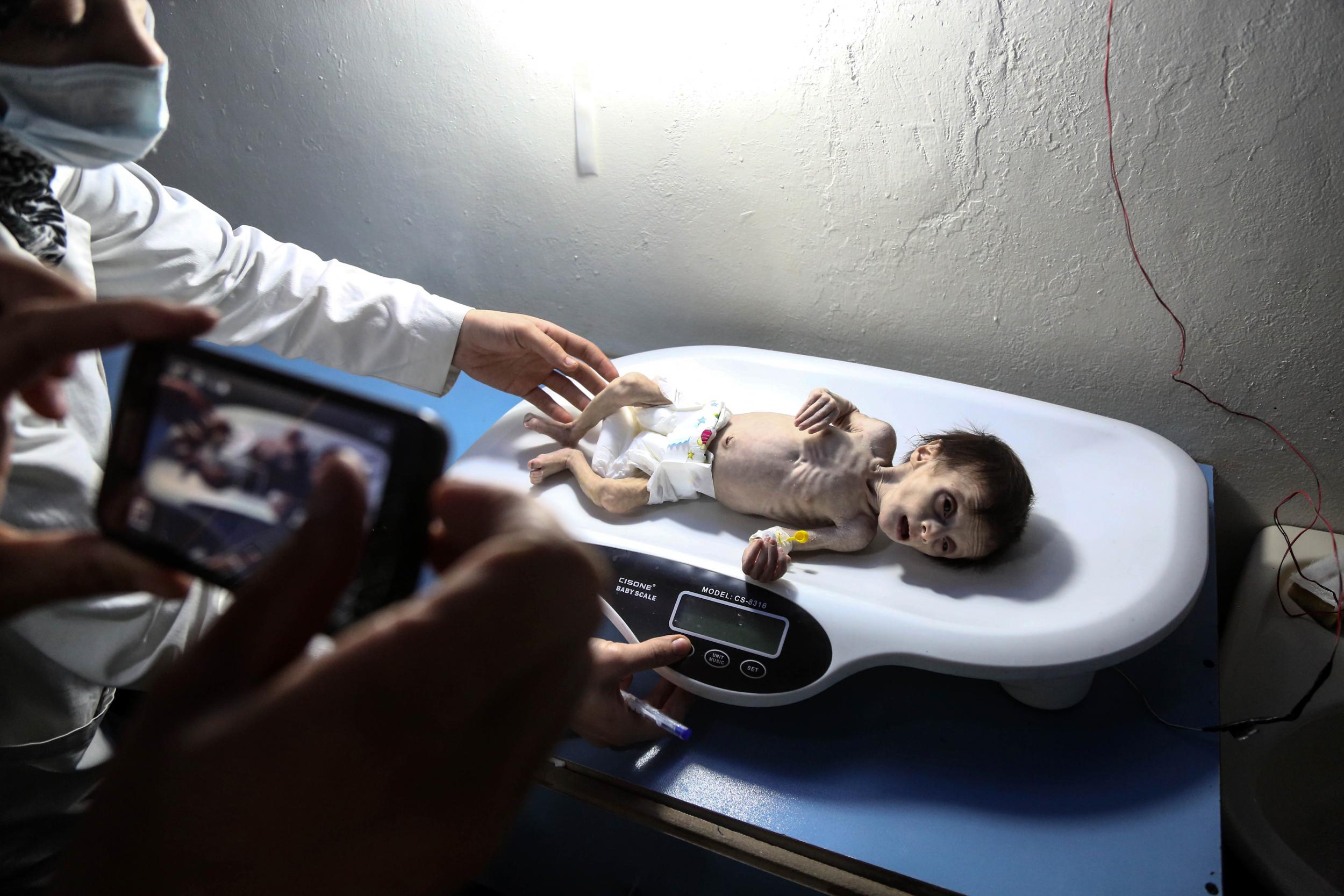 &#13;
Samar weighed just 1.9 kg (four pounds) when she was admitted by her also malnourished mother (AFP/Getty)&#13;