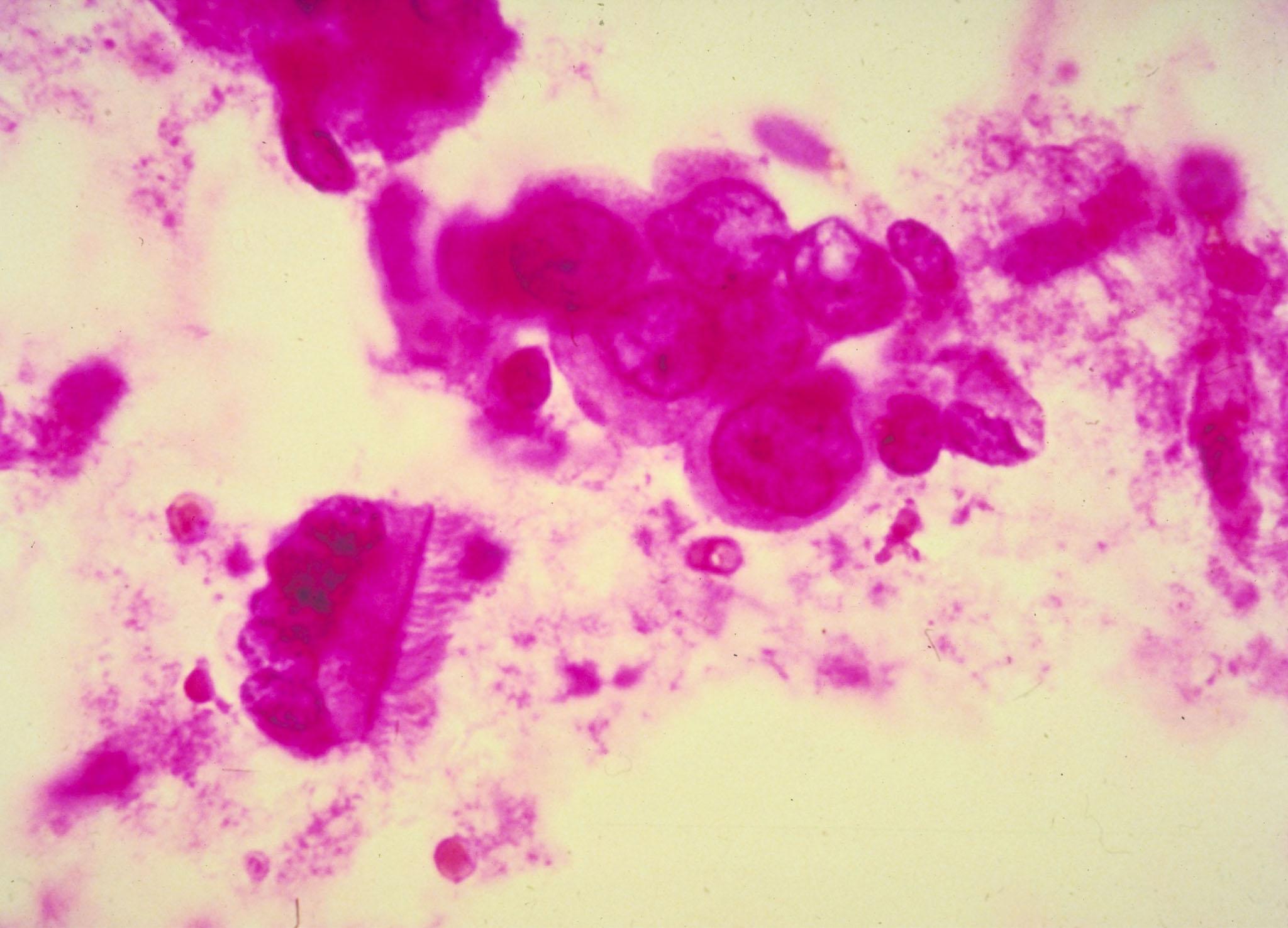 Detail of breast cancer cells. Breast cancer is a malignant growth that begins in the tissues of the breast. Over a lifetime, one in eight women is diagnosed with breast cancer