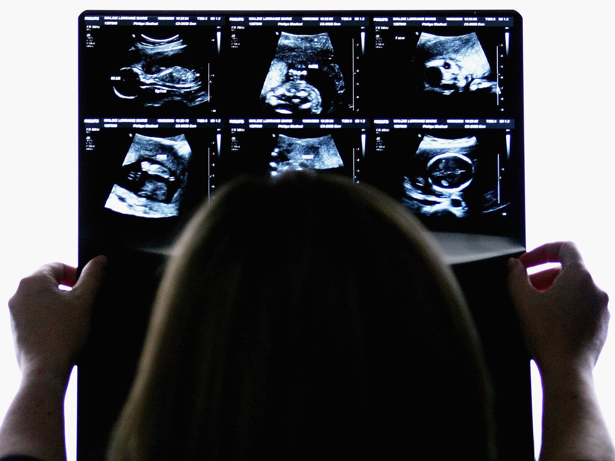 A pregnant woman examines her 18-week ultrasound scan pictures