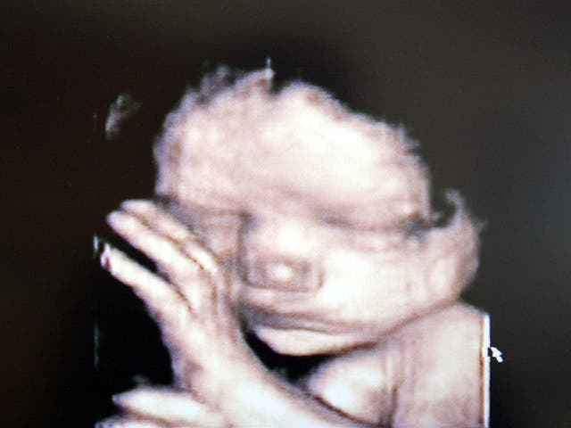 A 3D ultrasound showing a baby inside the womb