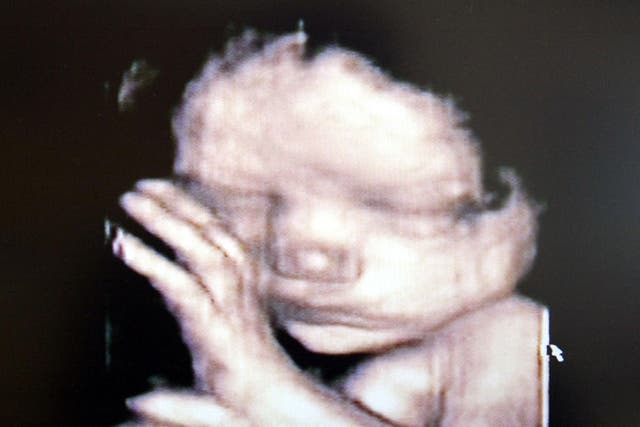 A 3D ultrasound showing a baby inside the womb