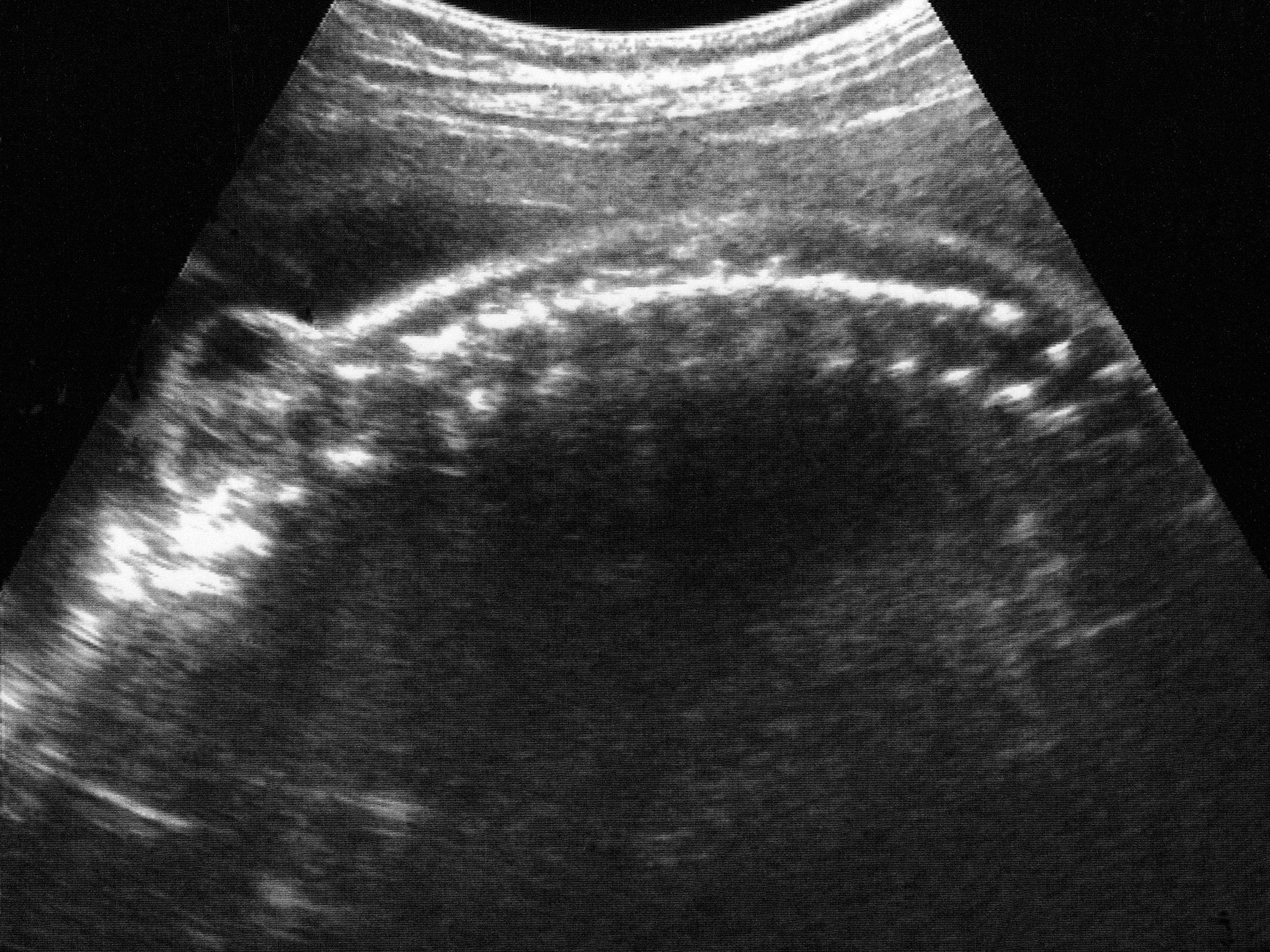 An ultrasound scan showing a baby suffering from spina bifida