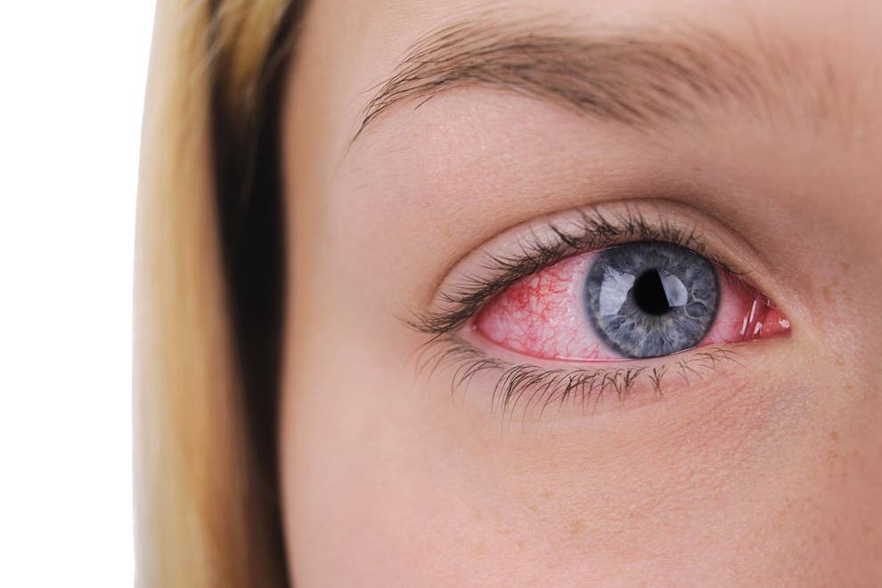 Ocular syphilis outbreak The inflammatory eye disease that can make