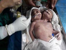 'One-in-a-million' twins born with two heads and same torso