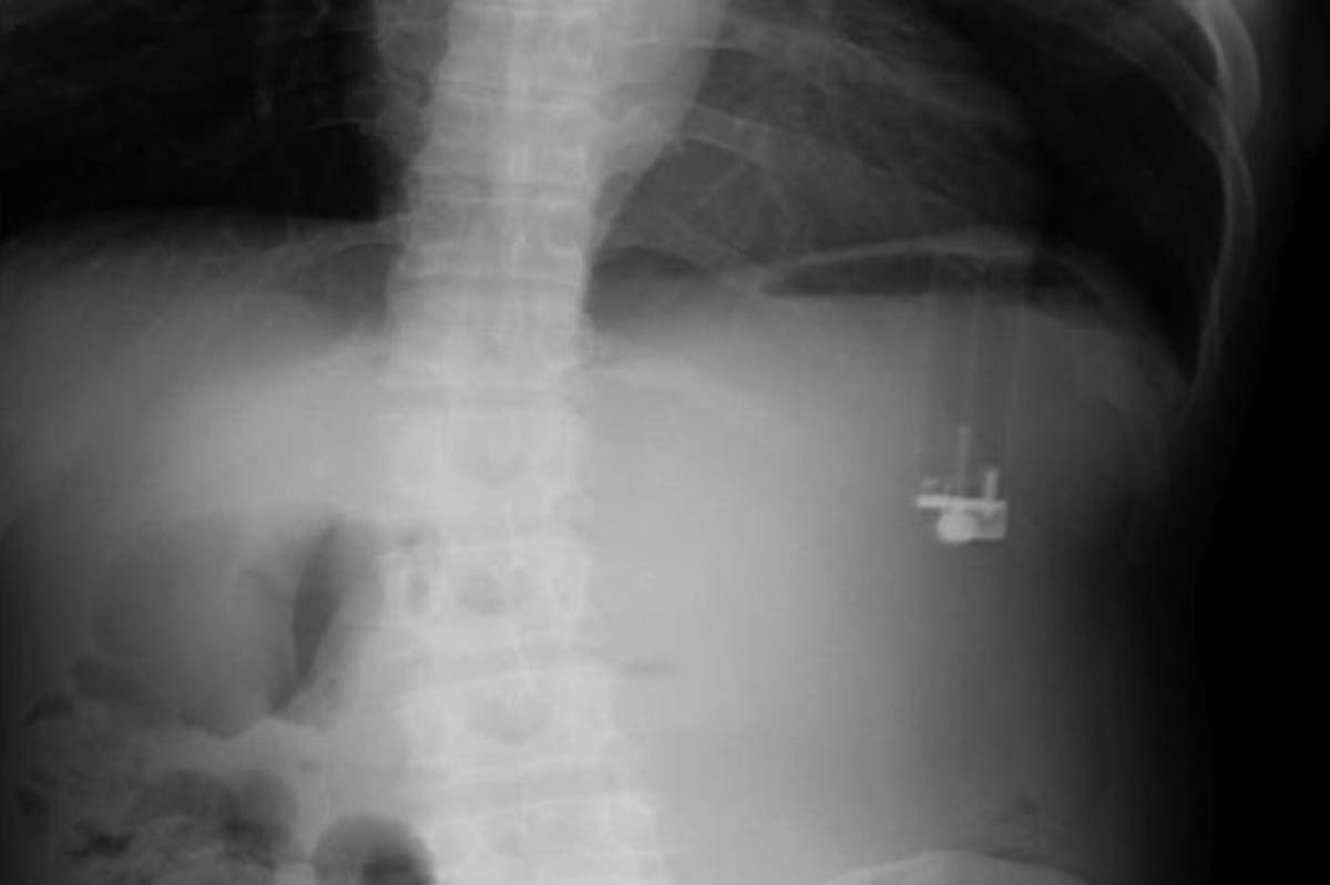 Man's constant stomach ache turns out to be a cigarette lighter leaking